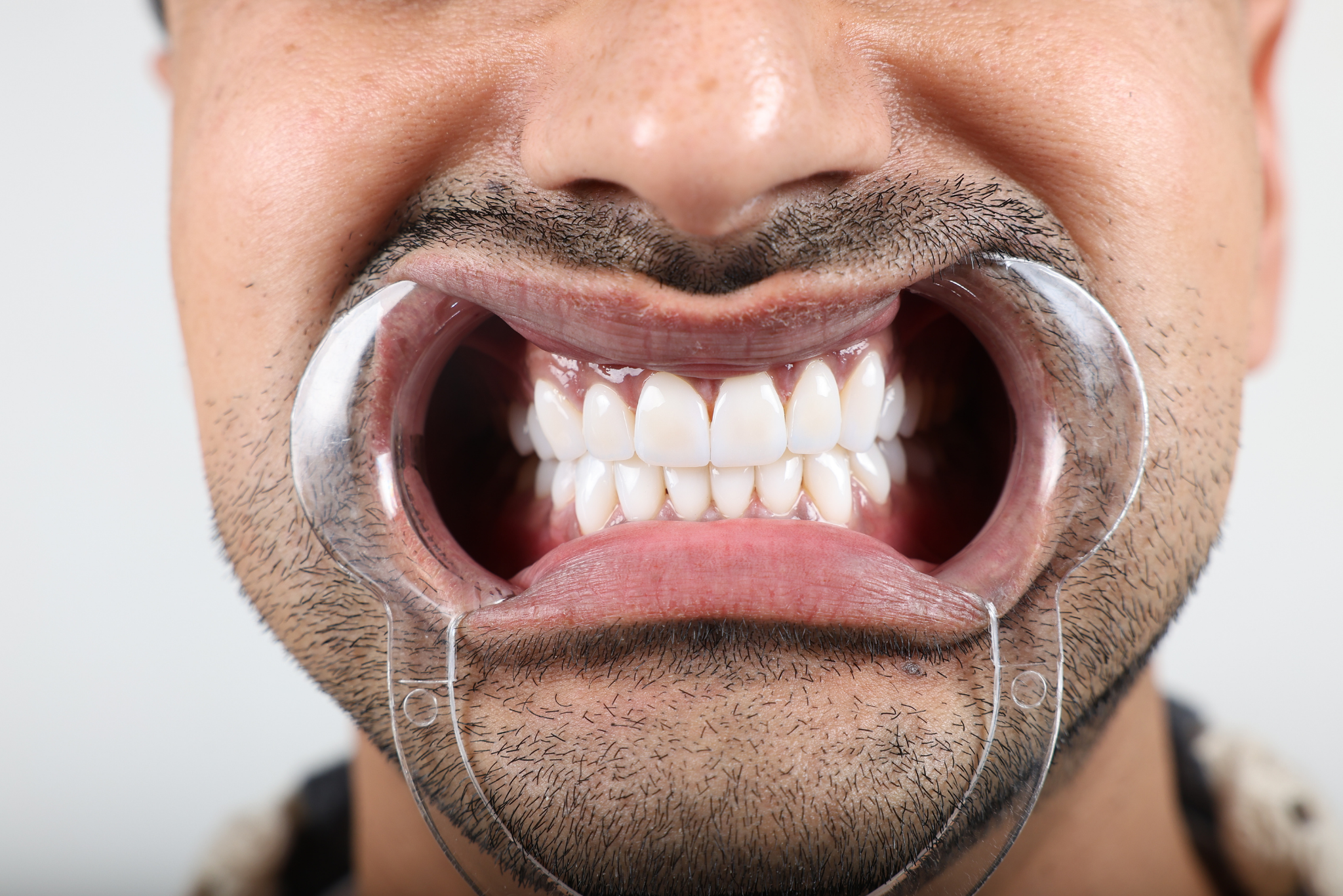 After E-max Veneer Treatment